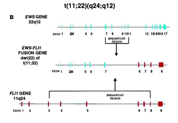 Figure 1: EWS/FLI1 type 1 fusion gene Ewings Research