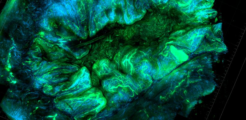 Ovarian Tumor Microenviroment, NCI Cancer Close Up